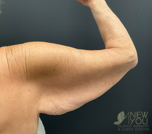 arm-lift-03a-before