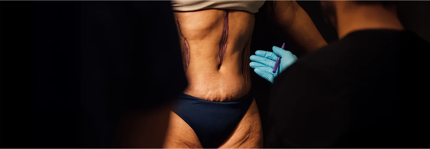 A close-up view of a person's abdomen and hips, with pre-surgical markings drawn in purple marker on the skin. A gloved hand is holding a marker near the person's torso.