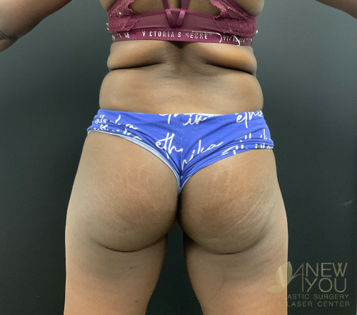 brazilian-butt-lift-08a-before