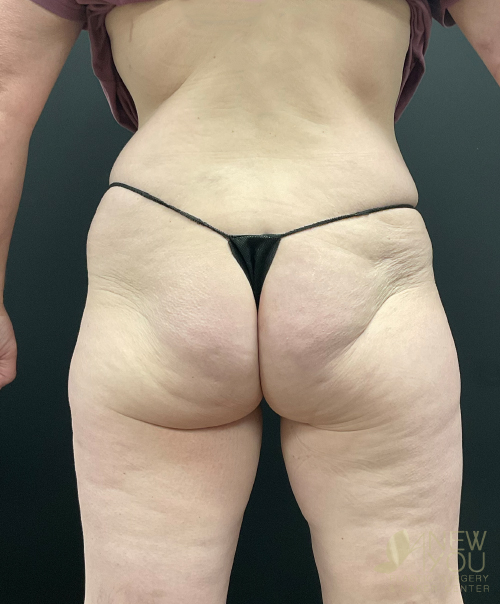 brazilian-butt-lift-10a-before