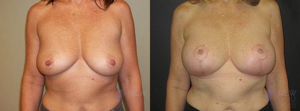 Real Patient Results by Dr. Shah of A New You Plastic Surgery & Medical Spa in Chicago, IL