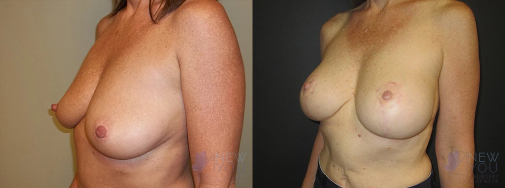 Real Patient Results by Dr. Shah of A New You Plastic Surgery & Medical Spa in Chicago, IL