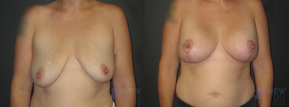 Real Patient Results by Dr. Shah of A New You Plastic Surgery & Medical Spa in Chicago, IL