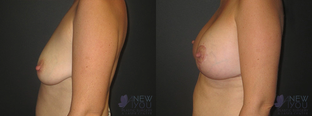 Real Patient Results by Dr. Shah of A New You Plastic Surgery & Medical Spa in Chicago, IL