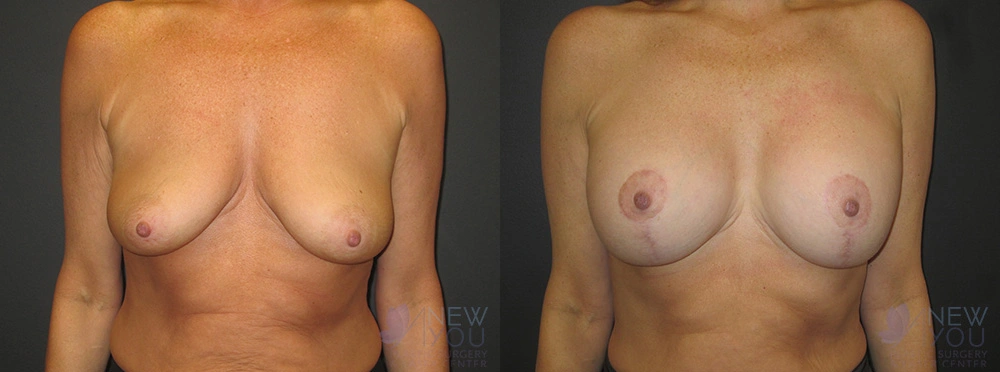 Real Patient Results by Dr. Shah of A New You Plastic Surgery & Medical Spa in Chicago, IL