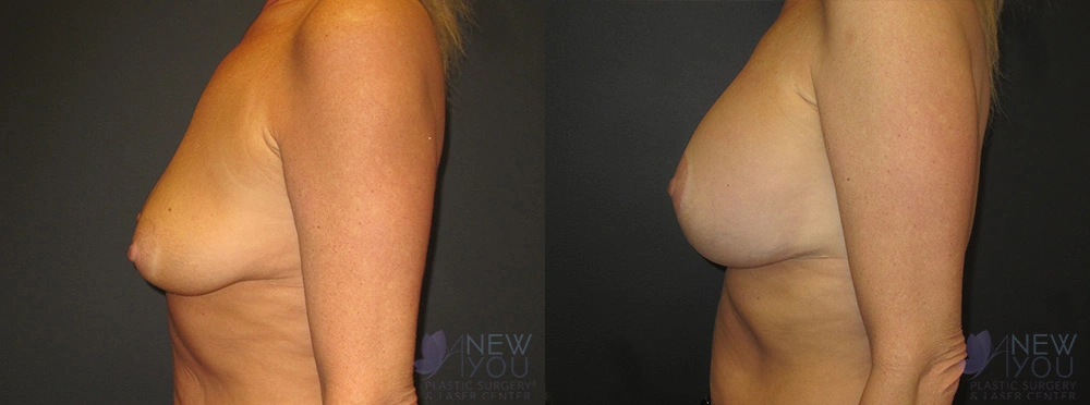 Real Patient Results by Dr. Shah of A New You Plastic Surgery & Medical Spa in Chicago, IL