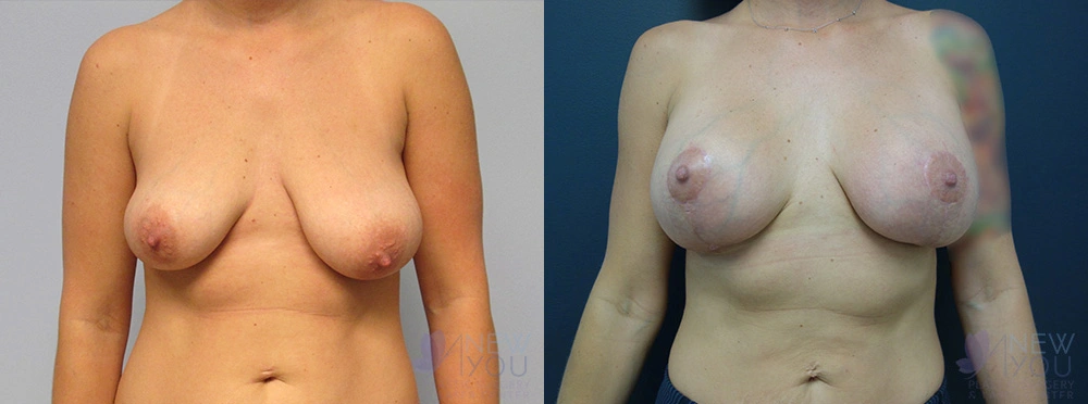 Real Patient Results by Dr. Shah of A New You Plastic Surgery & Medical Spa in Chicago, IL