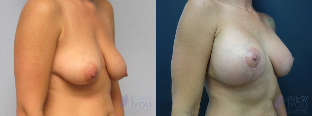 Real Patient Results by Dr. Shah of A New You Plastic Surgery & Medical Spa in Chicago, IL