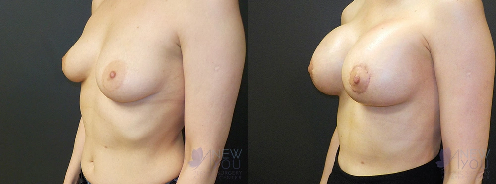 Real Patient Results by Dr. Shah of A New You Plastic Surgery & Medical Spa in Chicago, IL