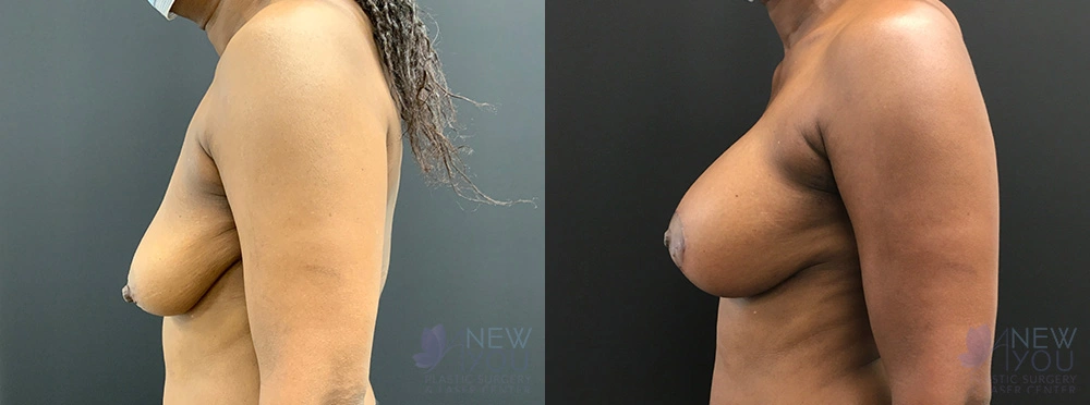 Real Patient Results by Dr. Shah of A New You Plastic Surgery & Medical Spa in Chicago, IL