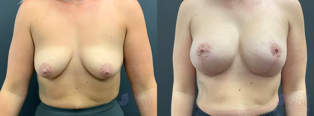 Real Patient Results by Dr. Shah of A New You Plastic Surgery & Medical Spa in Chicago, IL