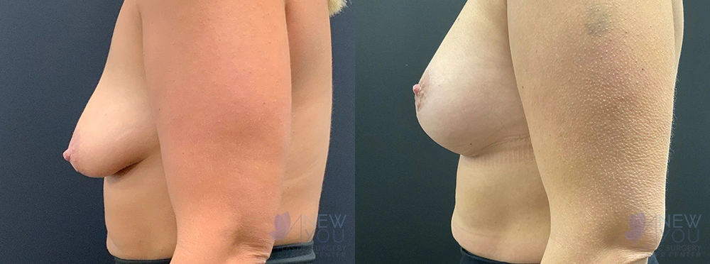 Real Patient Results by Dr. Shah of A New You Plastic Surgery & Medical Spa in Chicago, IL