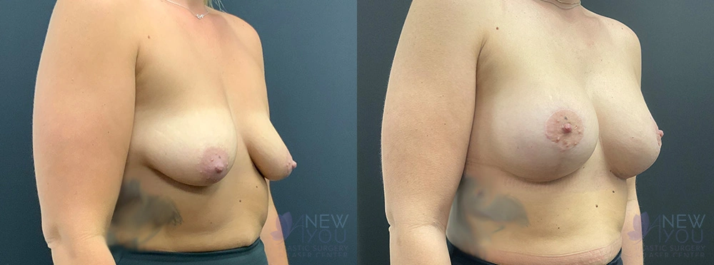 Real Patient Results by Dr. Shah of A New You Plastic Surgery & Medical Spa in Chicago, IL