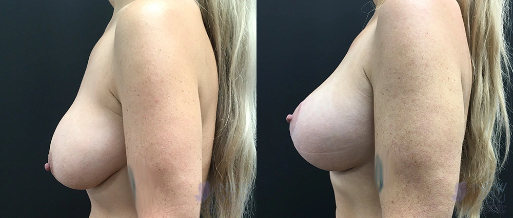 Real Patient Results by Dr. Shah of A New You Plastic Surgery & Medical Spa in Chicago, IL