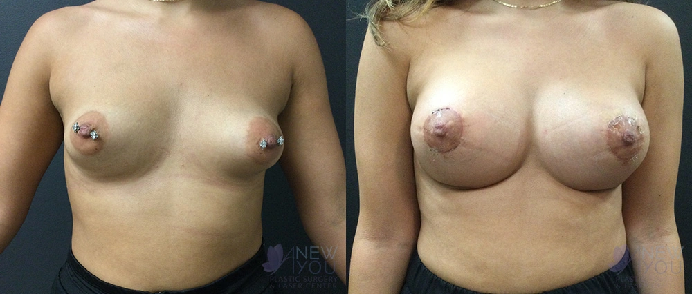 Real Patient Results by Dr. Shah of A New You Plastic Surgery & Medical Spa in Chicago, IL