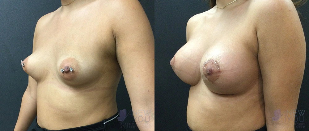 Real Patient Results by Dr. Shah of A New You Plastic Surgery & Medical Spa in Chicago, IL