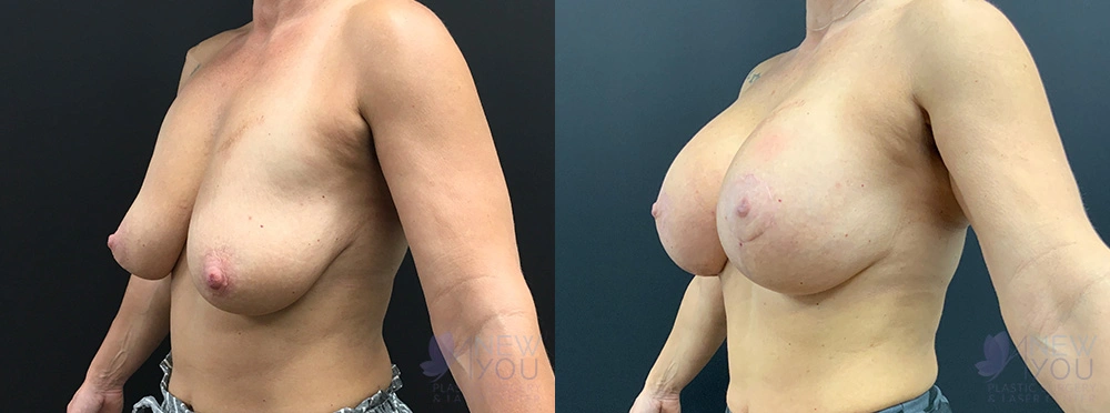 Real Patient Results by Dr. Shah of A New You Plastic Surgery & Medical Spa in Chicago, IL