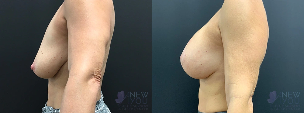 Real Patient Results by Dr. Shah of A New You Plastic Surgery & Medical Spa in Chicago, IL