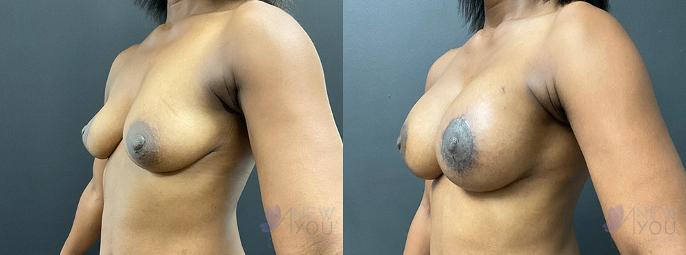 Real Patient Results by Dr. Shah of A New You Plastic Surgery & Medical Spa in Chicago, IL