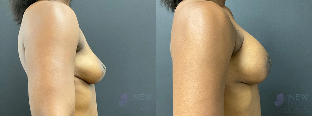 Real Patient Results by Dr. Shah of A New You Plastic Surgery & Medical Spa in Chicago, IL