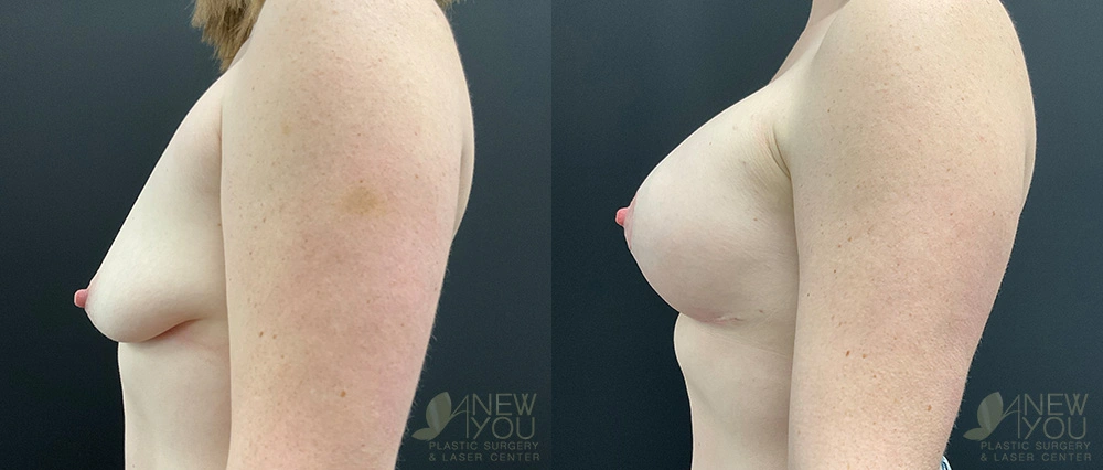 Real Patient Results by Dr. Shah of A New You Plastic Surgery & Medical Spa in Chicago, IL