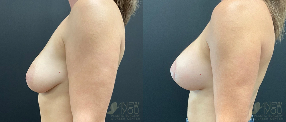 Real Patient Results by Dr. Shah of A New You Plastic Surgery & Medical Spa in Chicago, IL