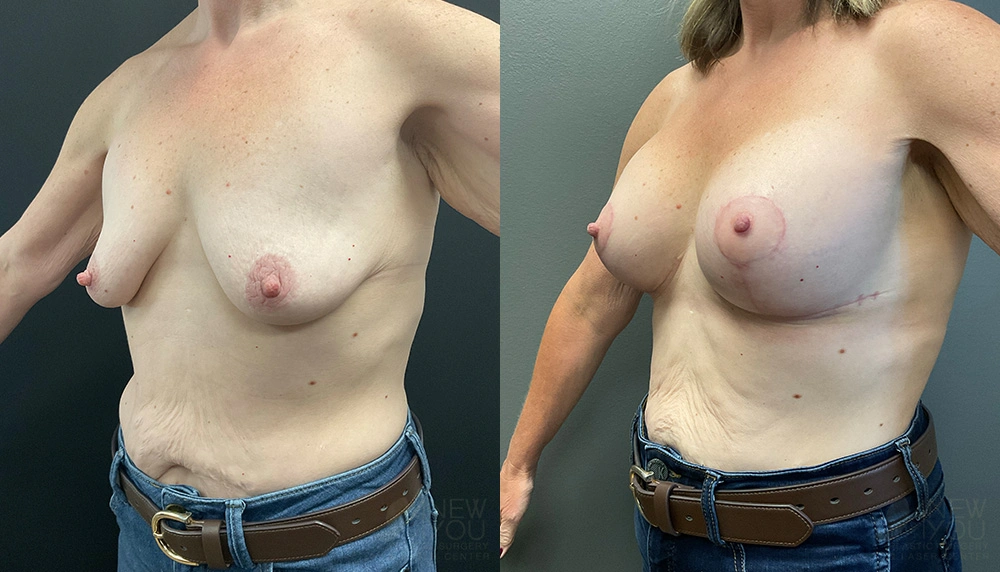 Real Patient Results by Dr. Shah of A New You Plastic Surgery & Medical Spa in Chicago, IL