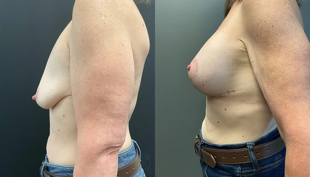 Real Patient Results by Dr. Shah of A New You Plastic Surgery & Medical Spa in Chicago, IL