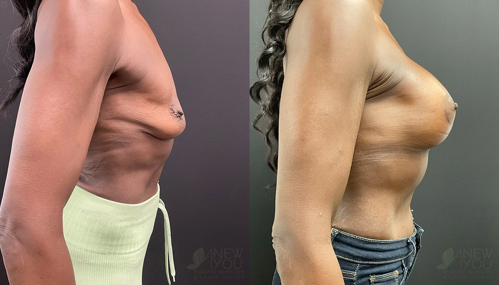 Real Patient Results by Dr. Shah of A New You Plastic Surgery & Medical Spa in Chicago, IL
