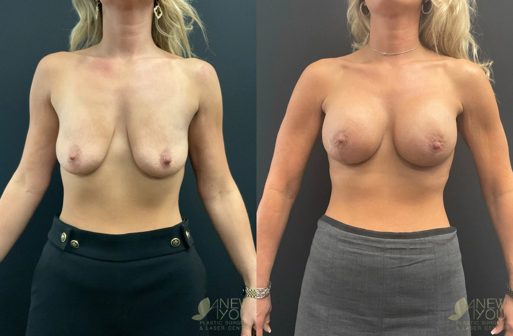 Real Patient Results by Dr. Shah of A New You Plastic Surgery & Medical Spa in Chicago, IL