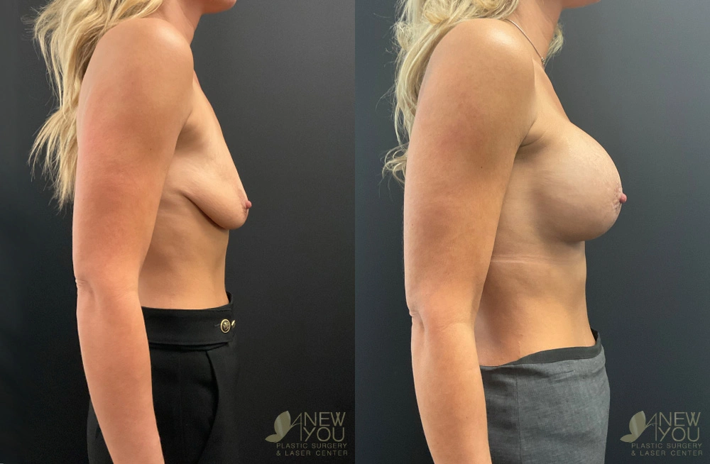 Real Patient Results by Dr. Shah of A New You Plastic Surgery & Medical Spa in Chicago, IL