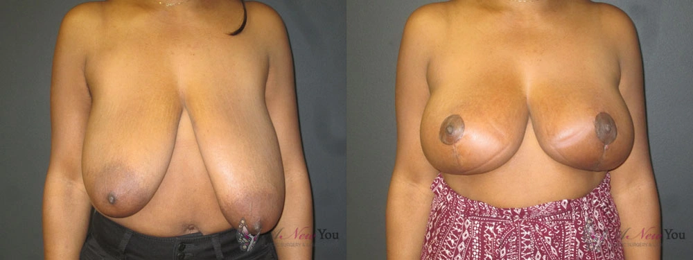 Real Patient Results by Dr. Shah of A New You Plastic Surgery & Medical Spa in Chicago, IL