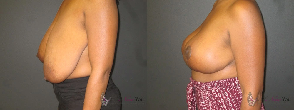 Real Patient Results by Dr. Shah of A New You Plastic Surgery & Medical Spa in Chicago, IL