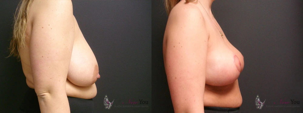 Real Patient Results by Dr. Shah of A New You Plastic Surgery & Medical Spa in Chicago, IL