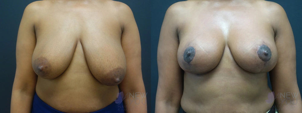 Real Patient Results by Dr. Shah of A New You Plastic Surgery & Medical Spa in Chicago, IL