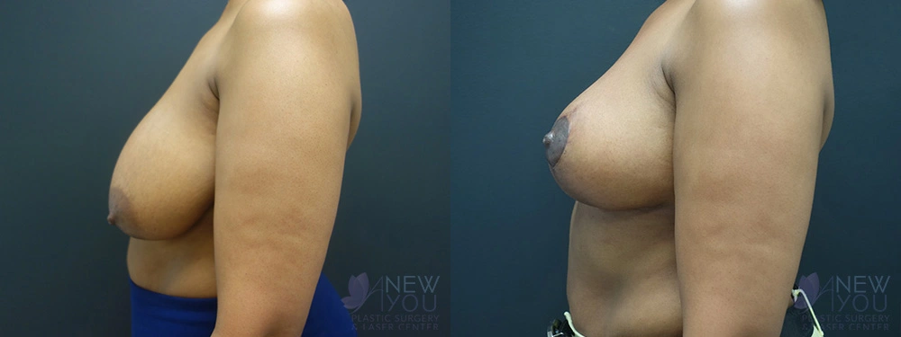 Real Patient Results by Dr. Shah of A New You Plastic Surgery & Medical Spa in Chicago, IL