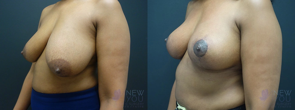 Real Patient Results by Dr. Shah of A New You Plastic Surgery & Medical Spa in Chicago, IL