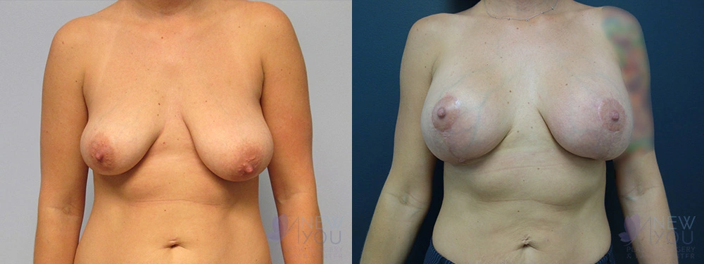Real Patient Results by Dr. Shah of A New You Plastic Surgery & Medical Spa in Chicago, IL
