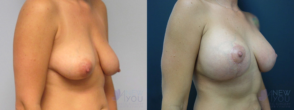 Real Patient Results by Dr. Shah of A New You Plastic Surgery & Medical Spa in Chicago, IL