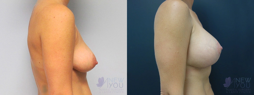 Real Patient Results by Dr. Shah of A New You Plastic Surgery & Medical Spa in Chicago, IL