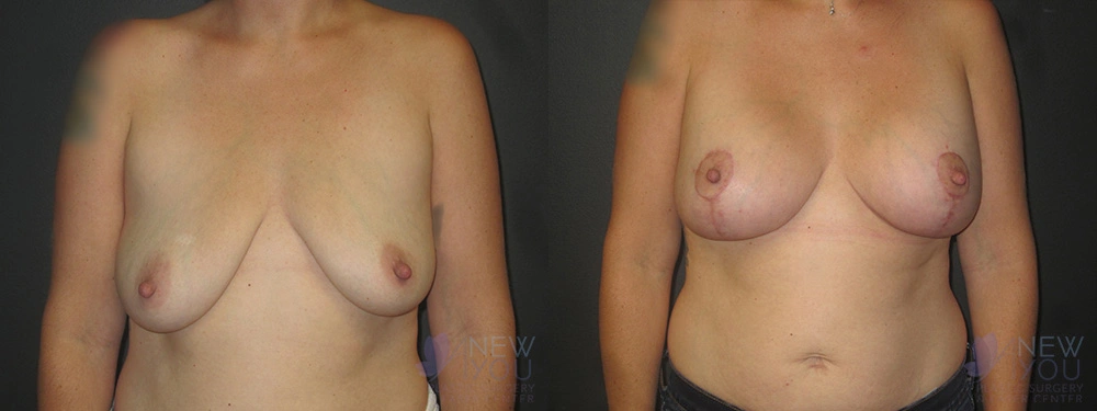 Real Patient Results by Dr. Shah of A New You Plastic Surgery & Medical Spa in Chicago, IL