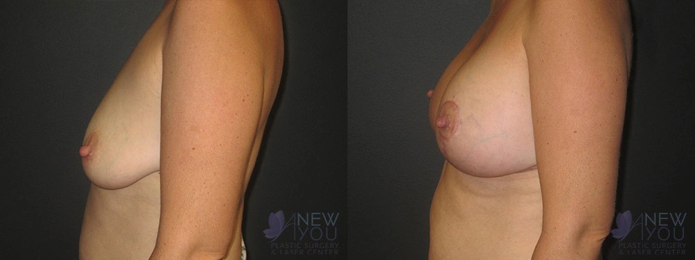 Real Patient Results by Dr. Shah of A New You Plastic Surgery & Medical Spa in Chicago, IL