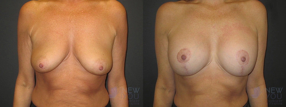 Real Patient Results by Dr. Shah of A New You Plastic Surgery & Medical Spa in Chicago, IL