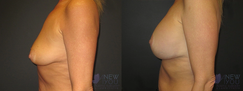 Real Patient Results by Dr. Shah of A New You Plastic Surgery & Medical Spa in Chicago, IL