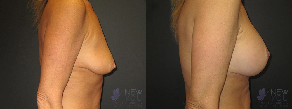 Real Patient Results by Dr. Shah of A New You Plastic Surgery & Medical Spa in Chicago, IL