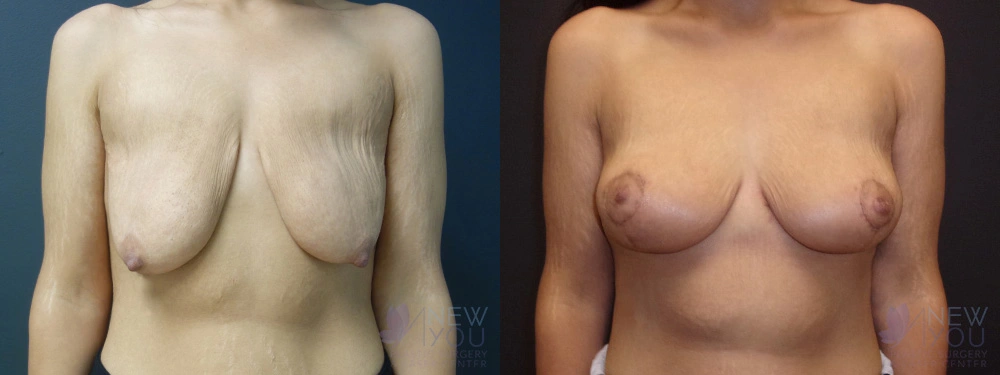 Real Patient Results by Dr. Shah of A New You Plastic Surgery & Medical Spa in Chicago, IL