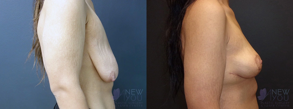 Real Patient Results by Dr. Shah of A New You Plastic Surgery & Medical Spa in Chicago, IL