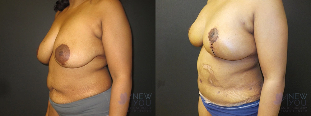 Real Patient Results by Dr. Shah of A New You Plastic Surgery & Medical Spa in Chicago, IL