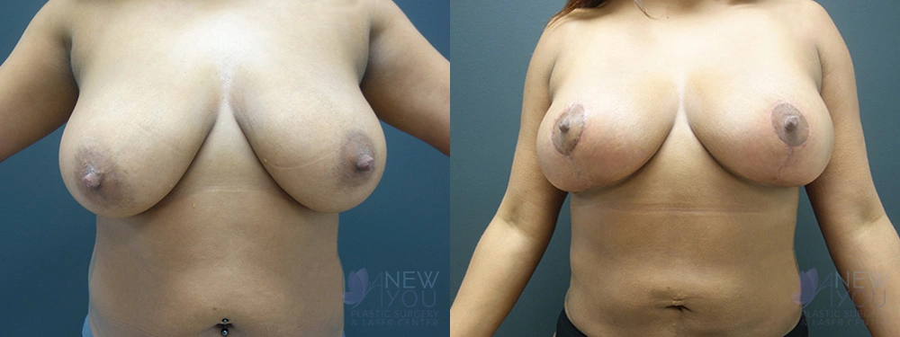 Real Patient Results by Dr. Shah of A New You Plastic Surgery & Medical Spa in Chicago, IL