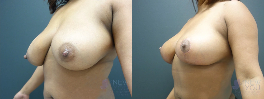 Real Patient Results by Dr. Shah of A New You Plastic Surgery & Medical Spa in Chicago, IL
